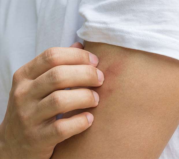 Corona Insect Bites and Stings Treatments